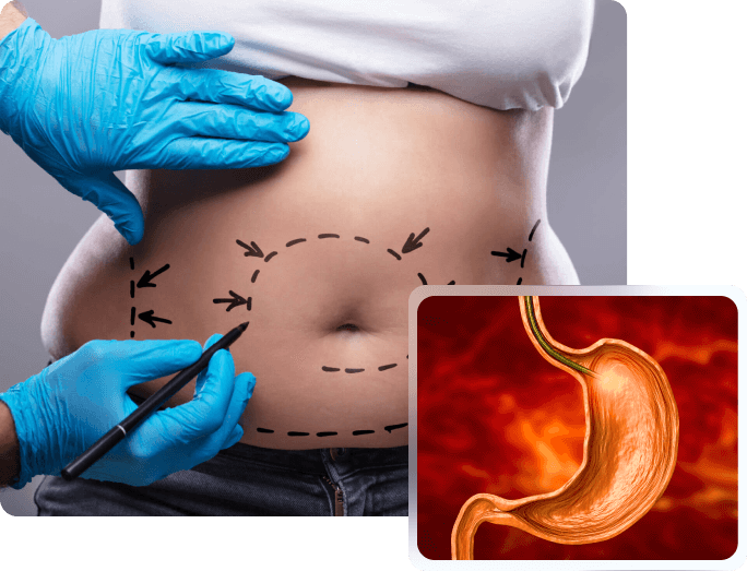 What Should Be Done After Gastric Sleeve Surgery