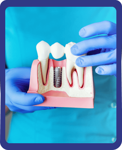 What Are The Types Of Dental Implants