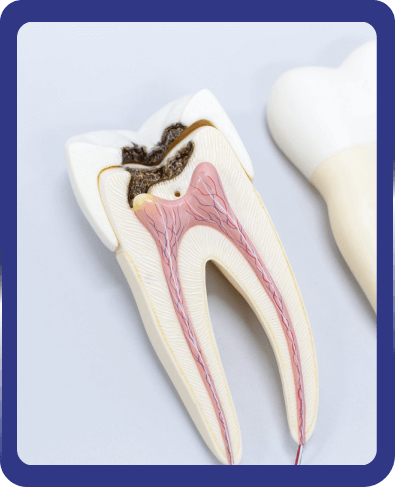 tooth root canal treatment