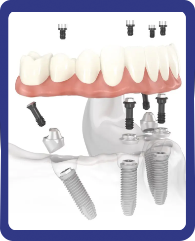 what is all on 4 dental implants process