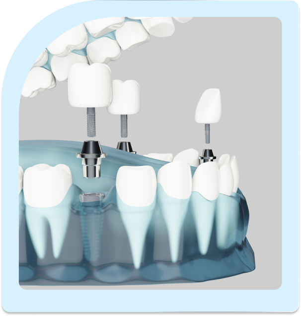 who can have all on 4 dental implants