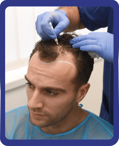 What Are The Hair Transplantation Stages