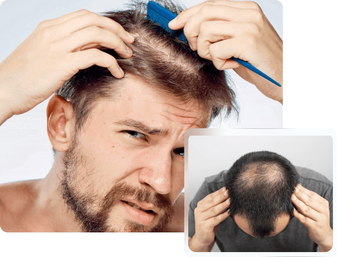 Who Can Have Hair Transplantation