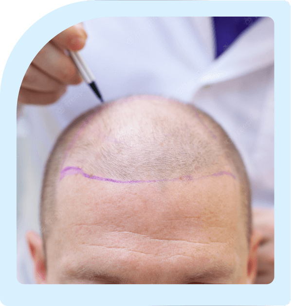 hair transplant process