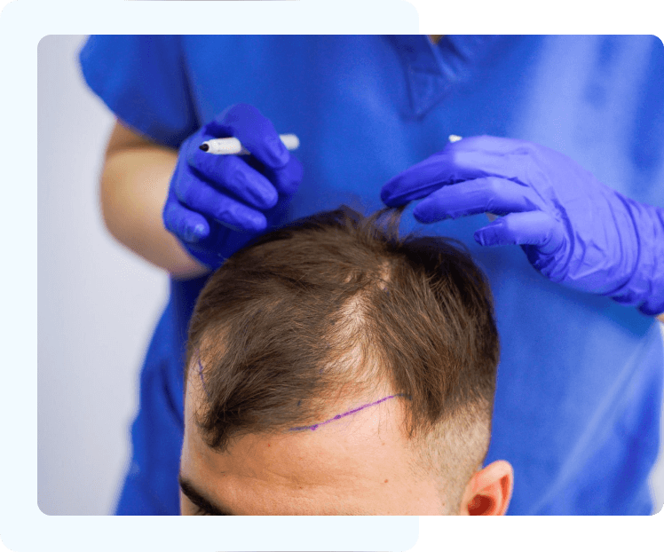 what is sapphire fue hair transplant