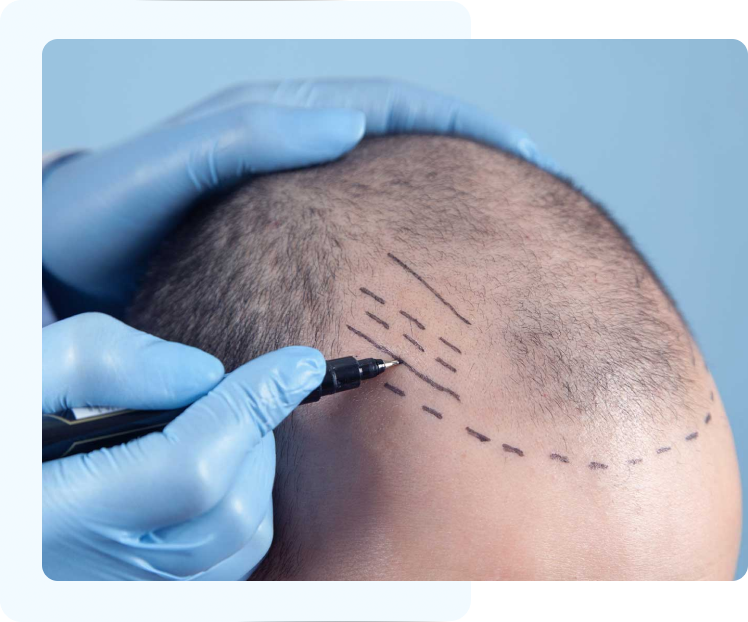 what is fue hair transplant