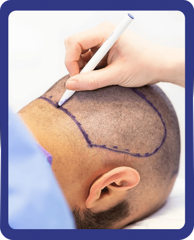 how is fue hair transplant applied