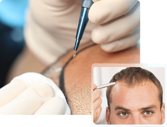 what is the aftercare of fue hair transplant