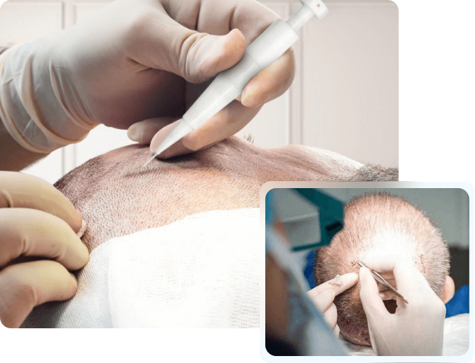 what are the advantages of DHI hair transplant