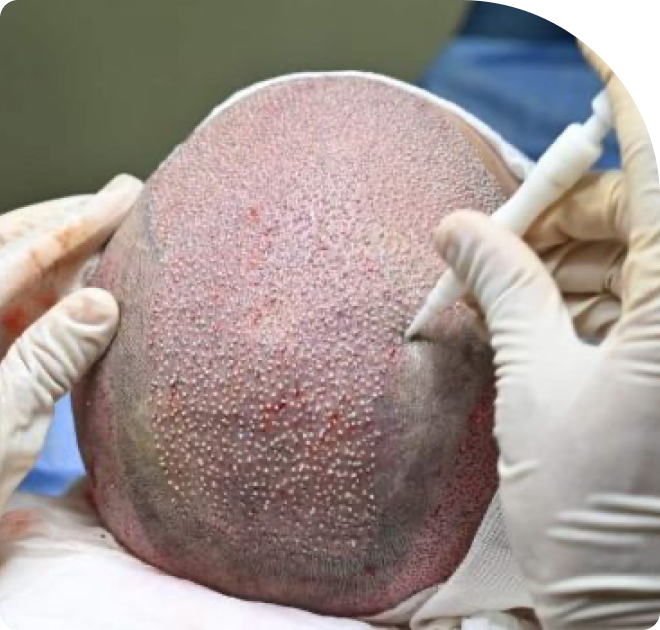 who is eligible for DHI Hair Transplant