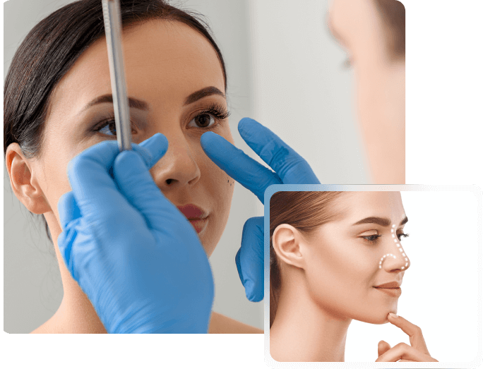 rhinoplasty