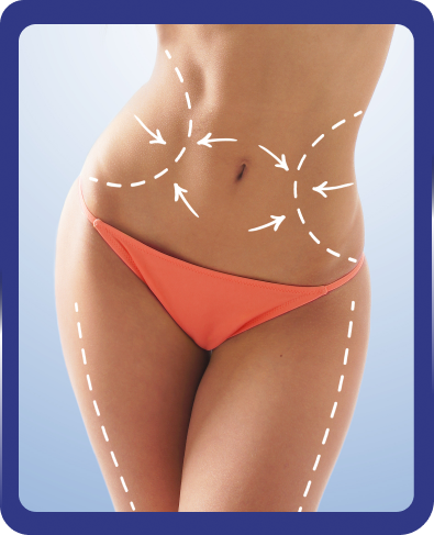 liposuction