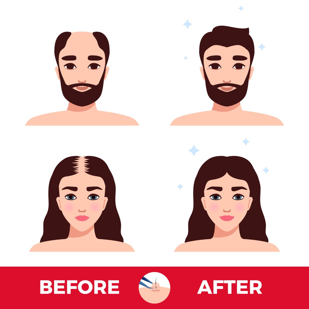 Illustration of Male and Female portraits Before/After hair transplantations