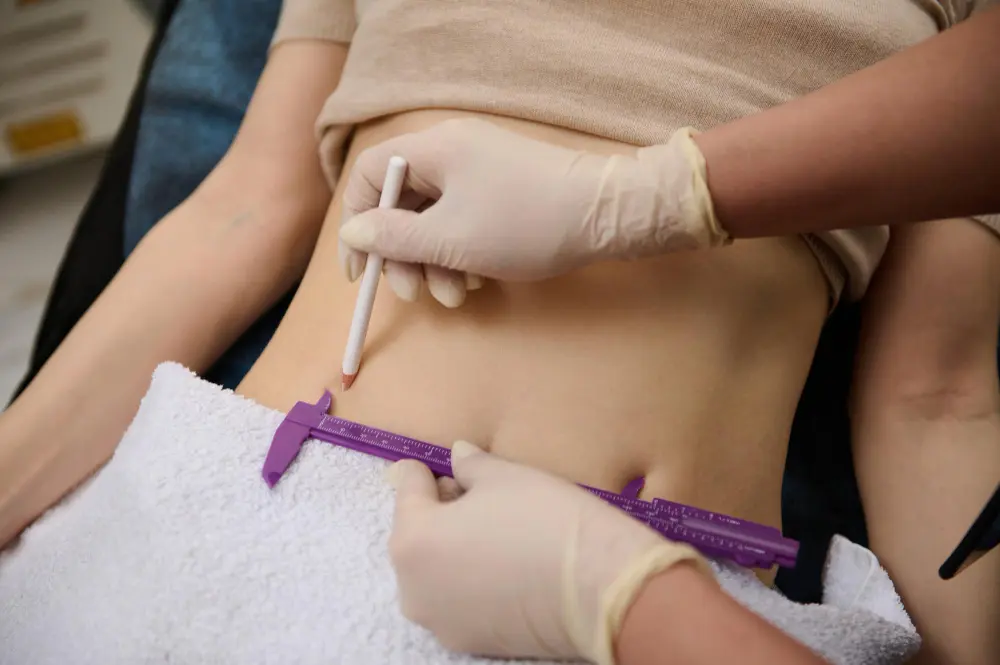 A woman getting her stomach measured before a Liposuction.