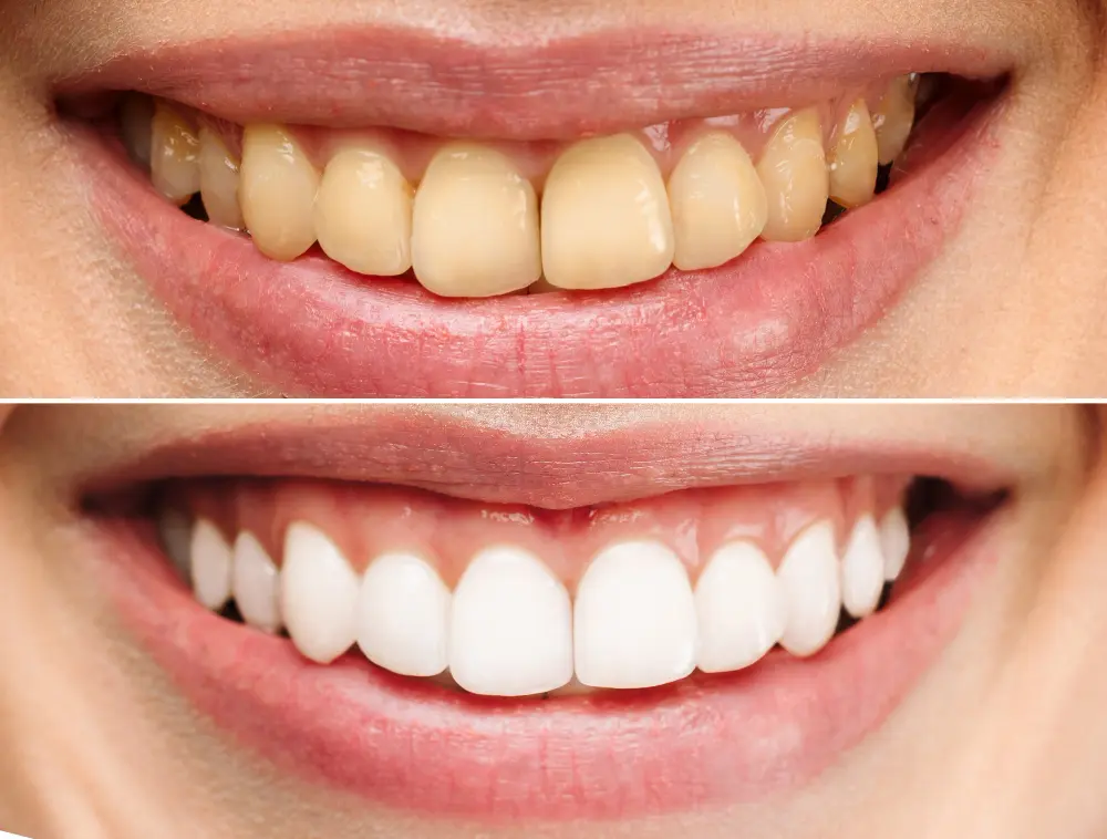 A woman teeth before and after Dental Bleaching 